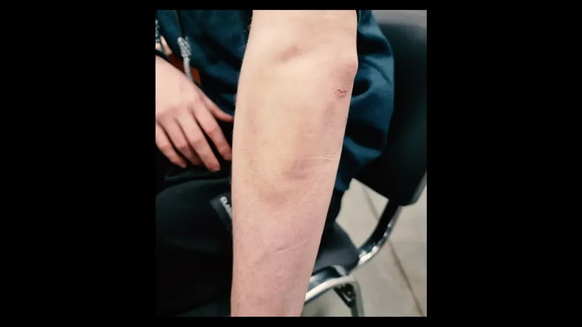 The photo of Lebedev's bruises. Screenshotet from YouTube