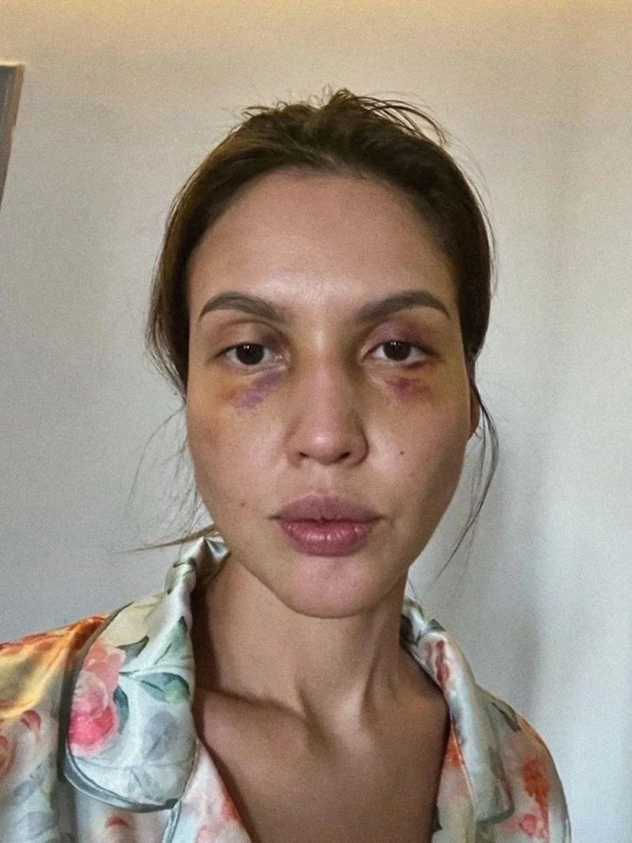 Saltanat after one of her husband’s beatings. Photo: Nukenova HELP / Telegram