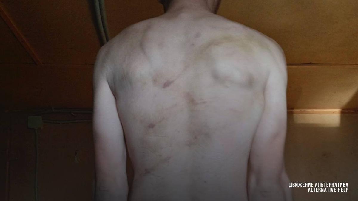Следы побоев на спине Вадима, зафиксированные после освобождения. Фото: Движение «Альтернатива»