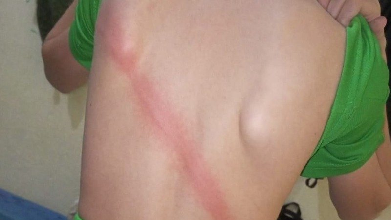 Спина шестиклассника, получившего от учителя ОБЖ удар нагайкой. Фото: соцсети