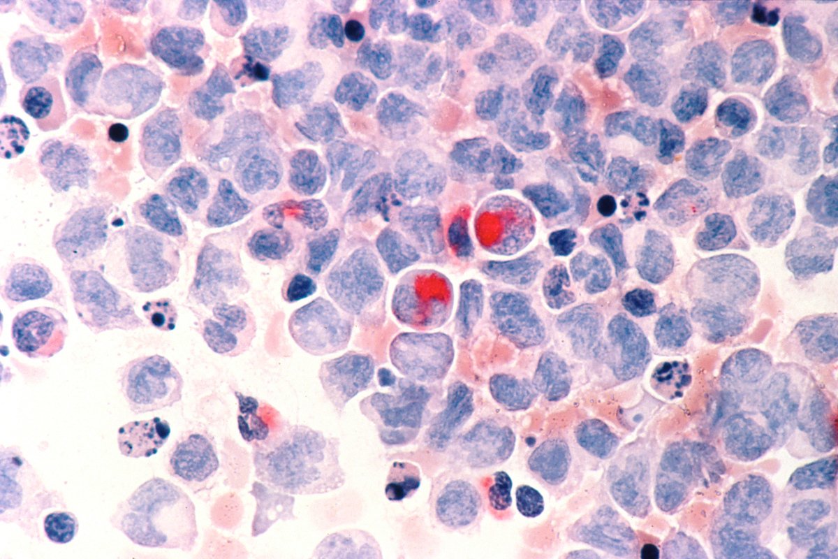 Клетки человека с острой миелоцитарной лейкемией под микроскопом. Фото: National Cancer Institute / AP / Scanpix / LETA