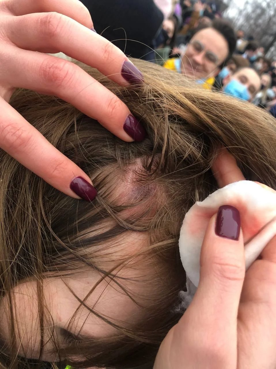 A protester sanitising Elizaveta’s head injury after she was hit with a baton. Photo courtesy of the author
