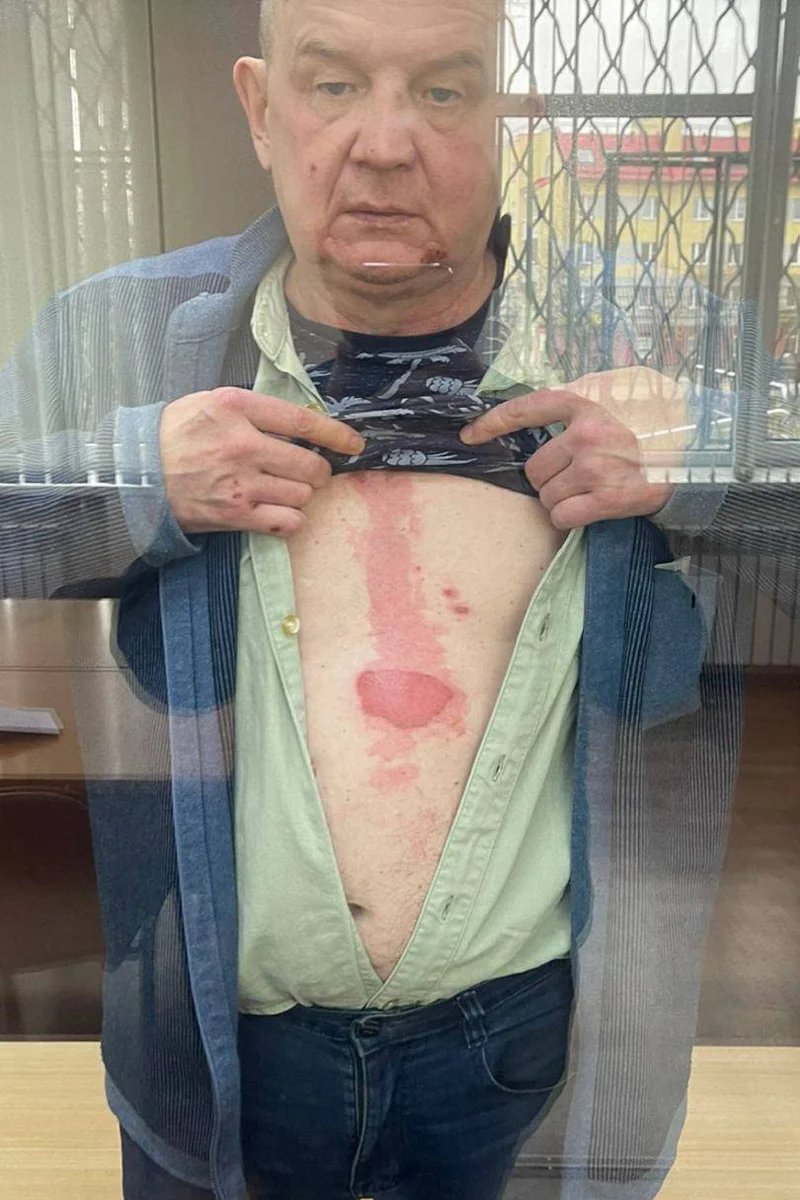 Sergey Veselov displaying his burns in court, April 2024. Photo: Oscar Cherdzhiev / Novaya Gazeta Baltic